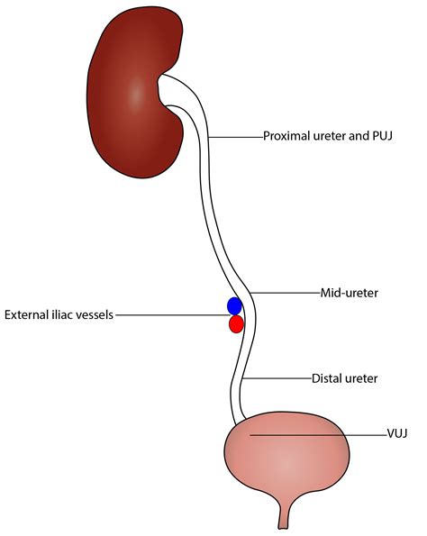 VesicoUreteric Junction (VUJ) Obstruction .